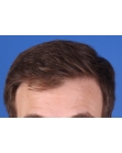 After Hair Transplant &nbsp;Front